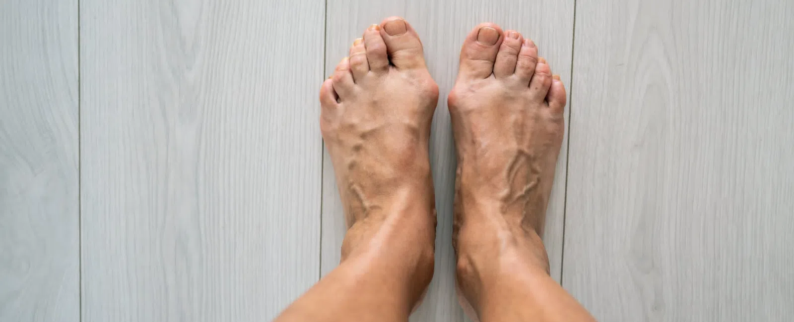 How to Prevent Varicose Veins: Real Tips That Actually Work