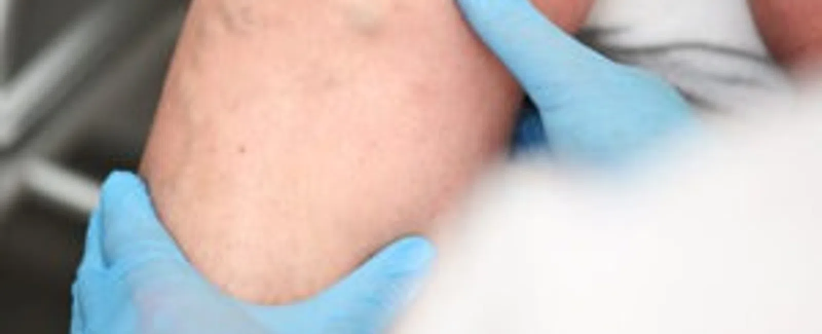 Management of Venous Insufficiency: What You Need to Know