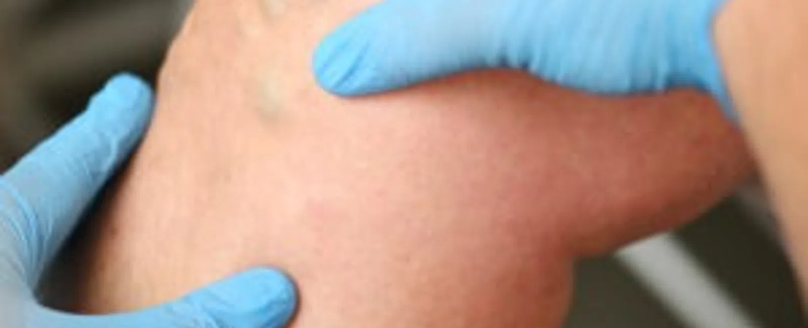 Signs and Symptoms of Venous Insufficiency: What Your Legs Are Trying to Tell You