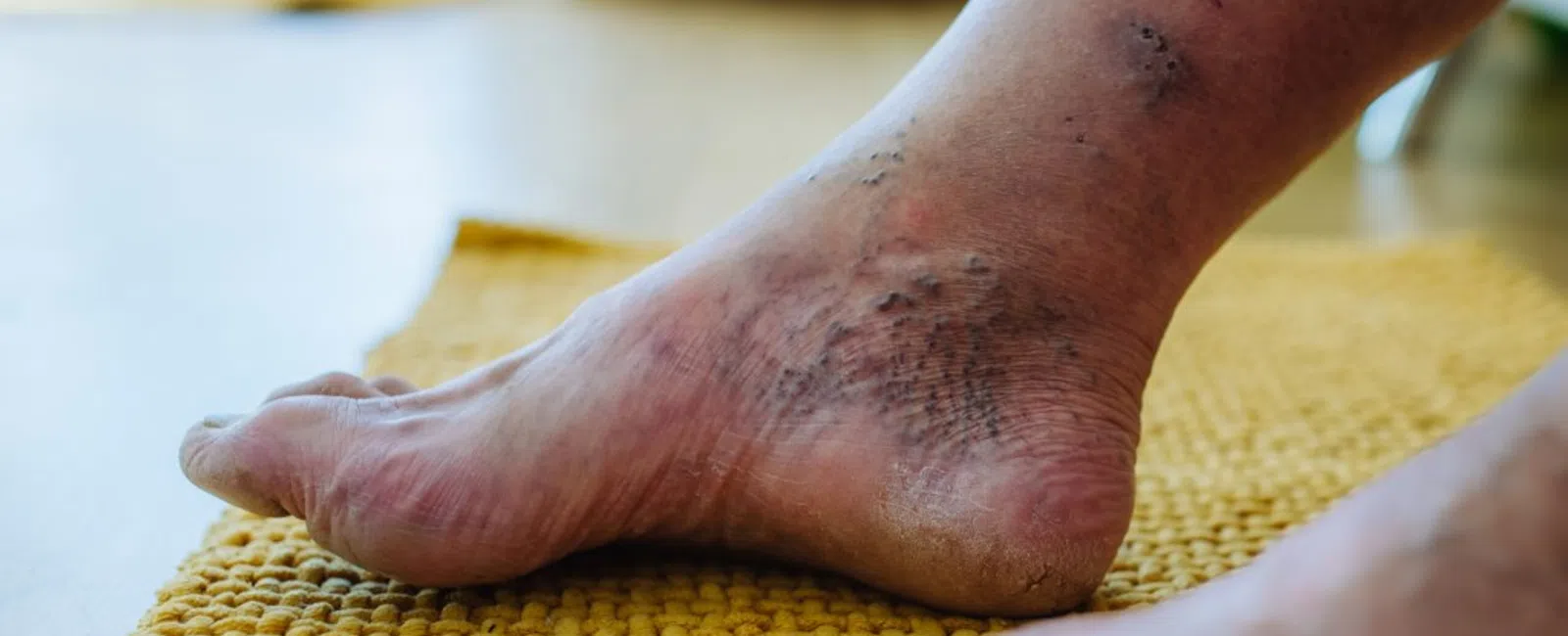 What Happens If Venous Insufficiency Is Not Treated?