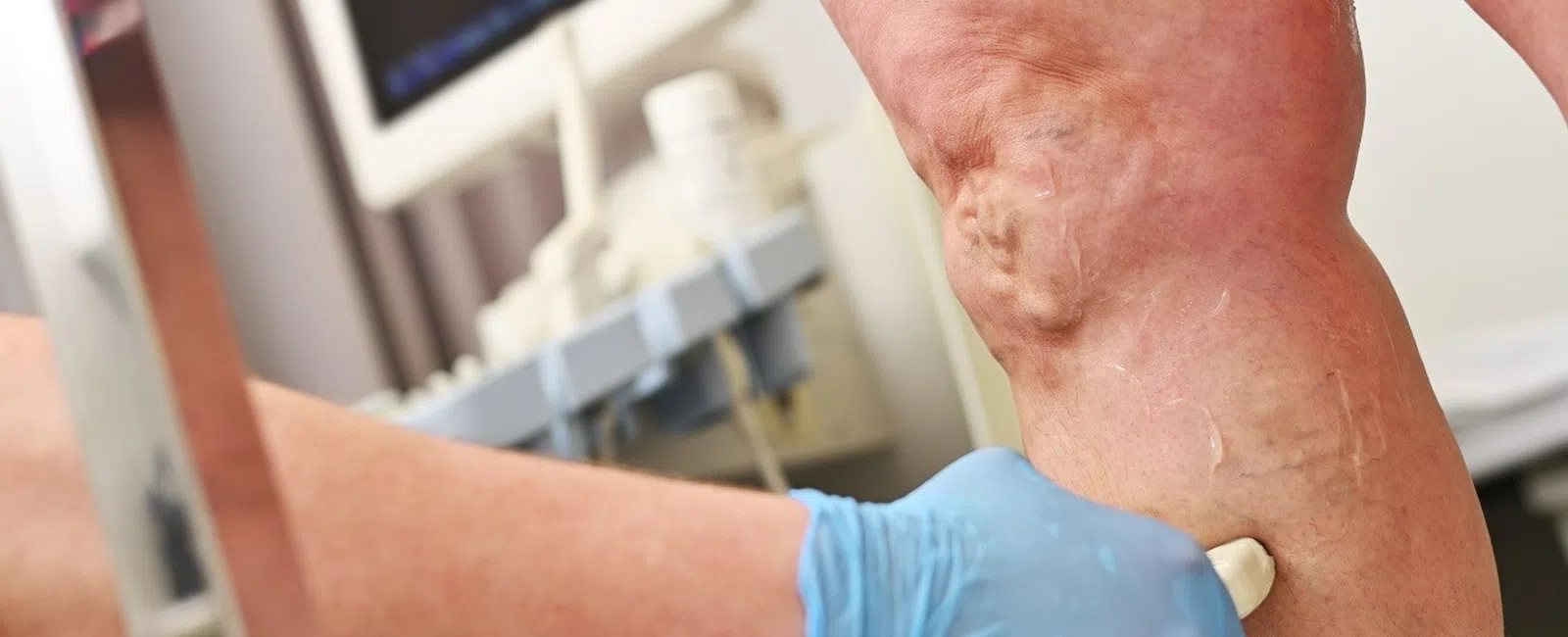 Vein Disease Is Everywhere in the News: But Here’s What Actually Matters for You