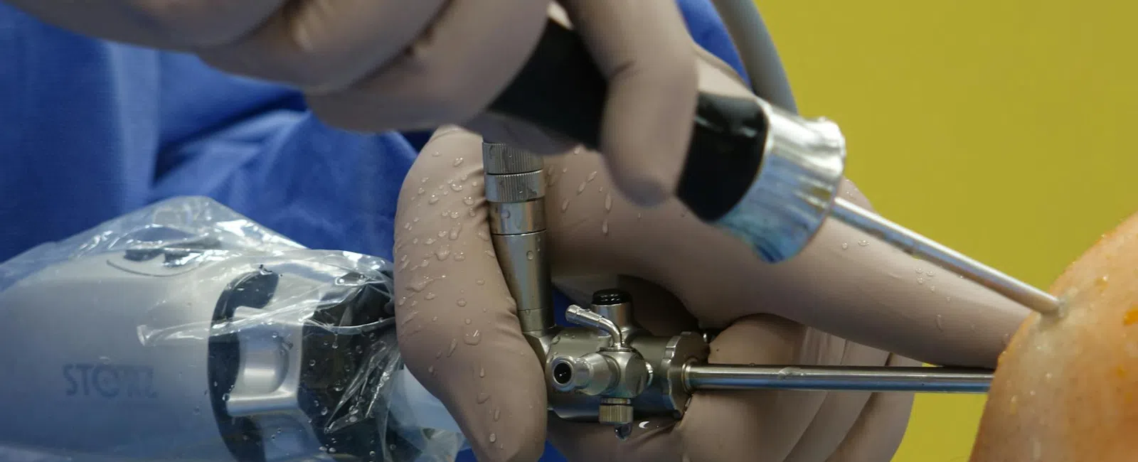 What Sleeve Gastrectomy Patients Need to Know About Barrett’s Esophagus