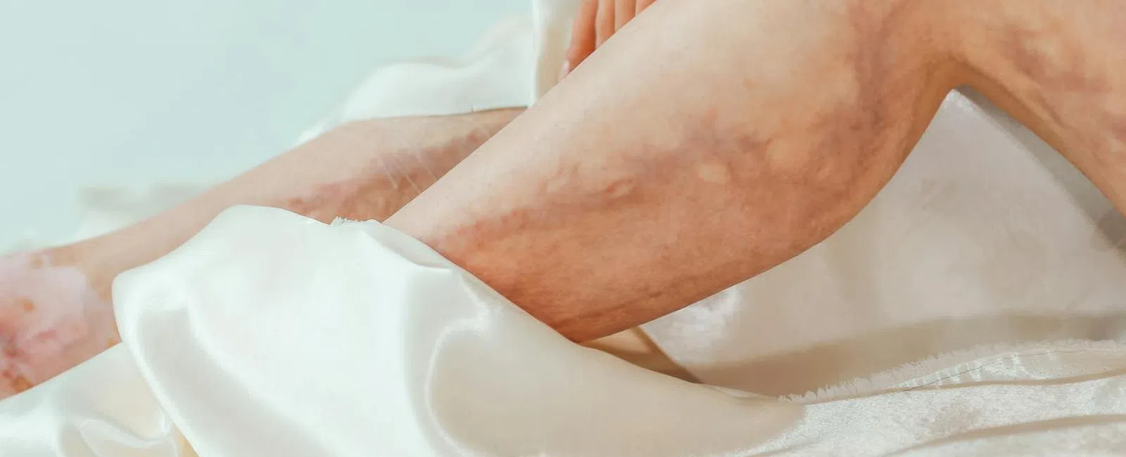 Varicose Veins: What Are They — And What Happens If You Don’t Treat Them?
