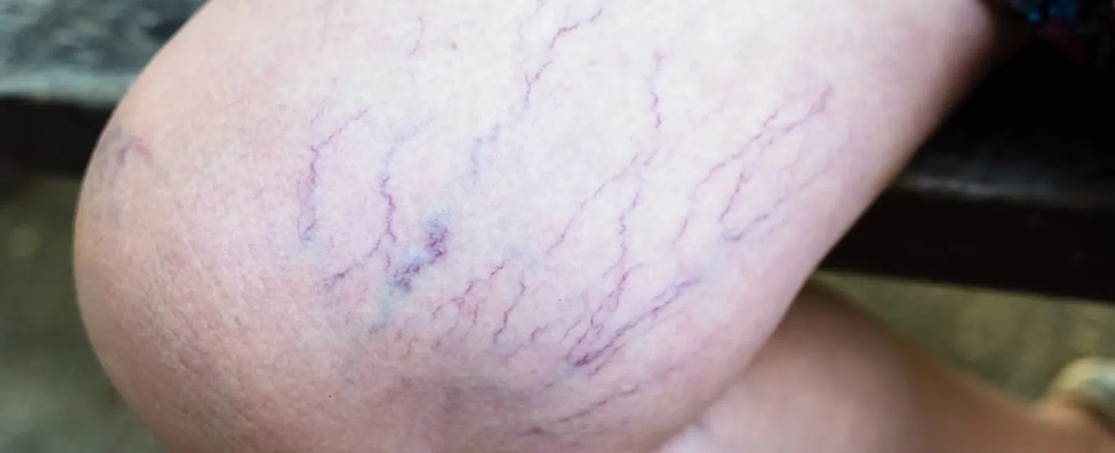 What is the most successful treatment for varicose veins?