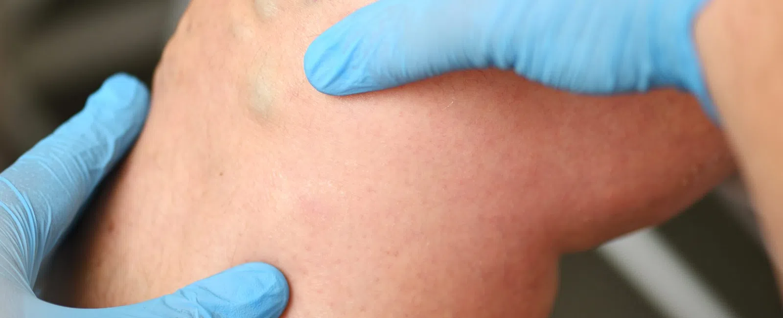 What is Venous Insufficiency, and How is It Linked to Obesity?
