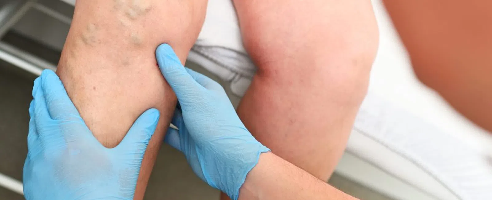 The Most Effective Treatments for Venous Insufficiency: What Really Works?