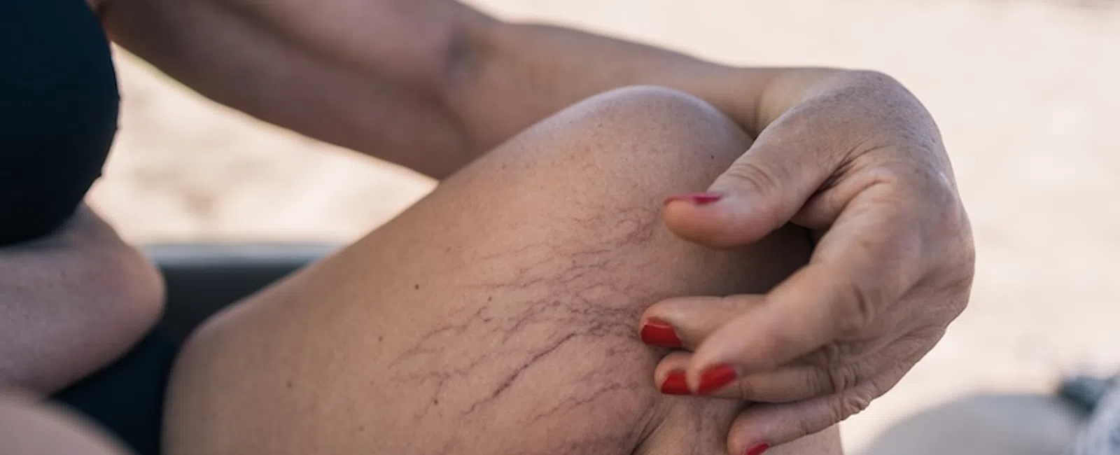When to Worry: Spider Veins vs. Varicose Veins (And Why It’s Not Just Cosmetic)