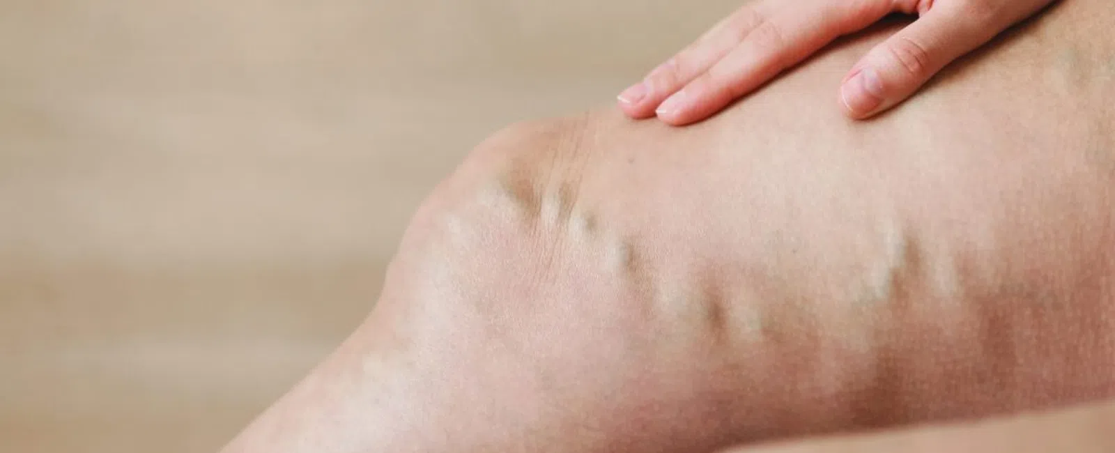 What You Need to Know About Treating Varicose Veins