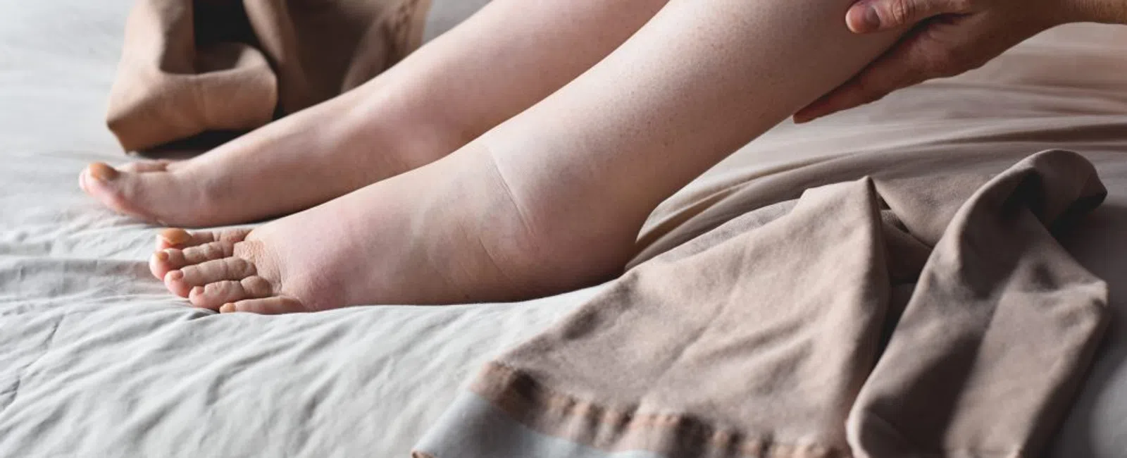 Understanding Chronic Venous Insufficiency