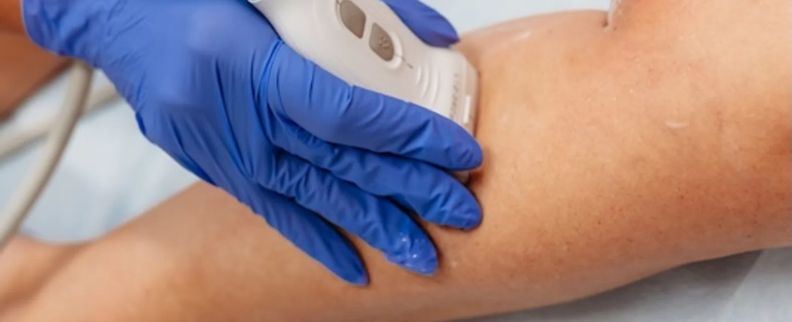 Spider Veins vs. Varicose Veins: What’s the Difference — and When Is It More Than Just Cosmetic?