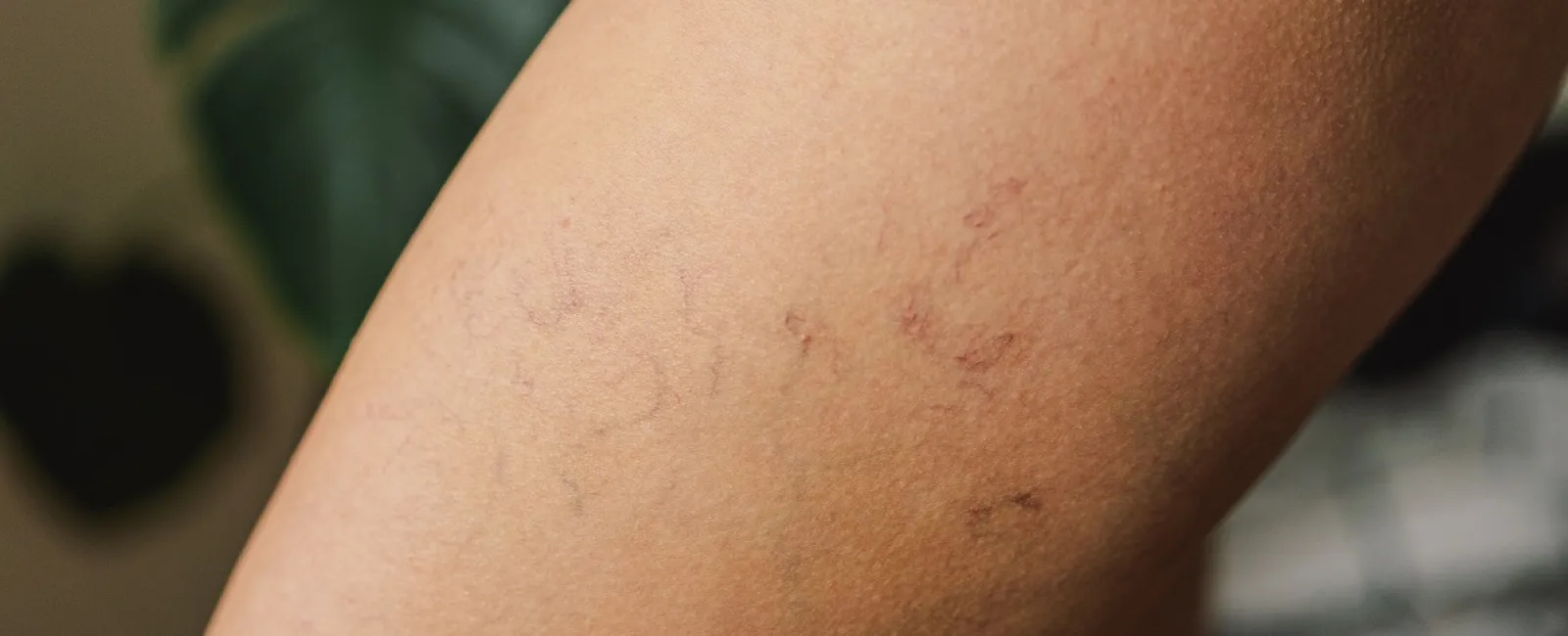 Is Asclera Right for You? A Clear Guide to Spider Vein Treatment