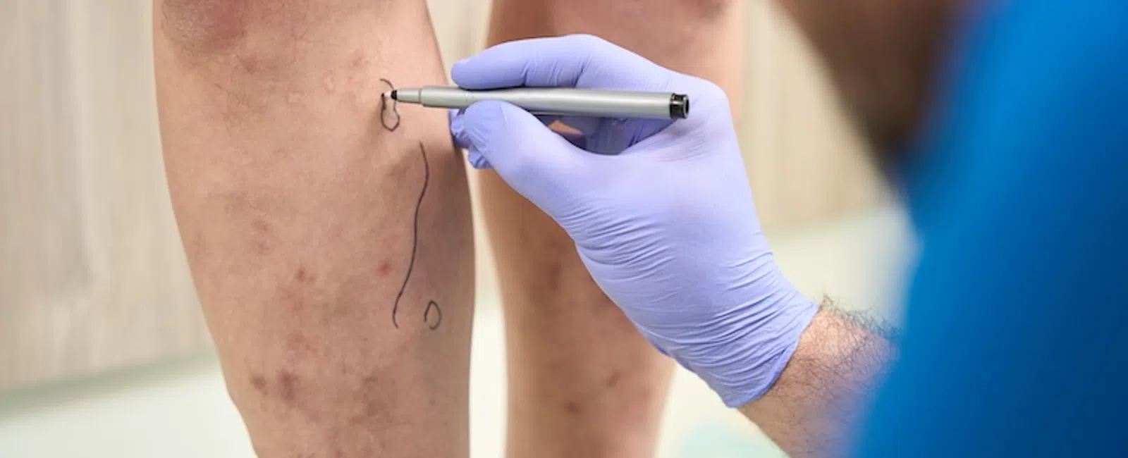 Heavy, Achy, Swollen Legs in 2026? Get Answers Before You Ignore It Again