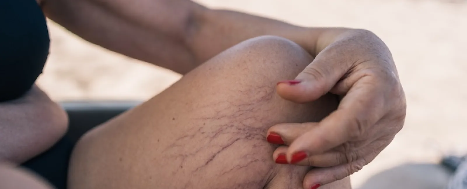 From Boots to Bare Legs: Why Winter is the Time to Fix Spider Veins
