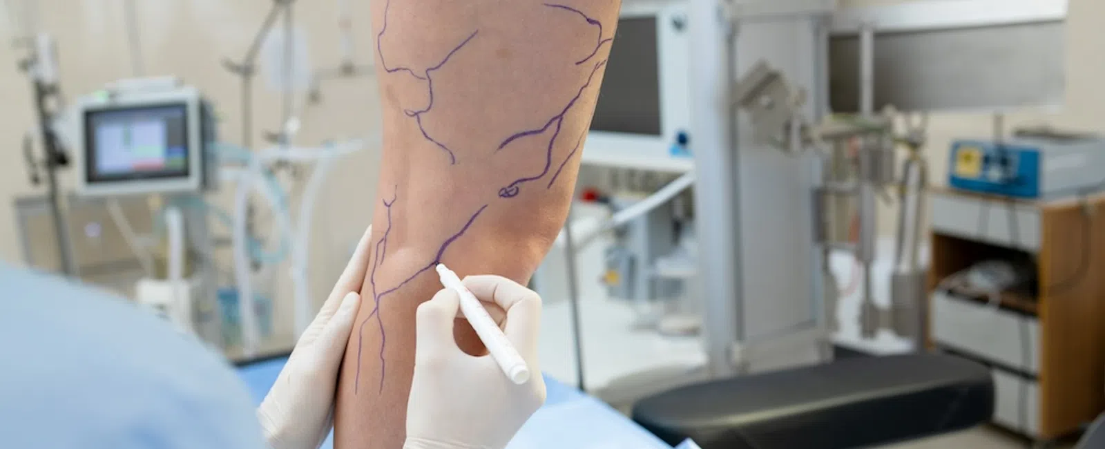 Do You Need a Vein Screening? Signs You Shouldn’t Ignore