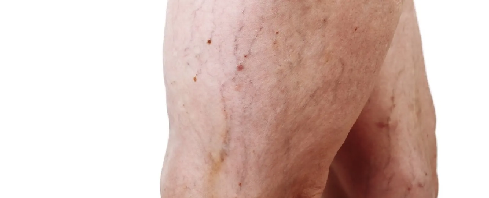 It’s Not Just “Getting Old”: Early Signs of Venous Insufficiency You Shouldn’t Ignore