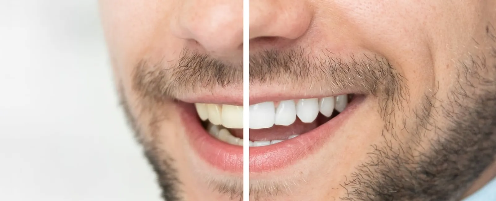 Reasons and Remedies for Tooth Discoloration