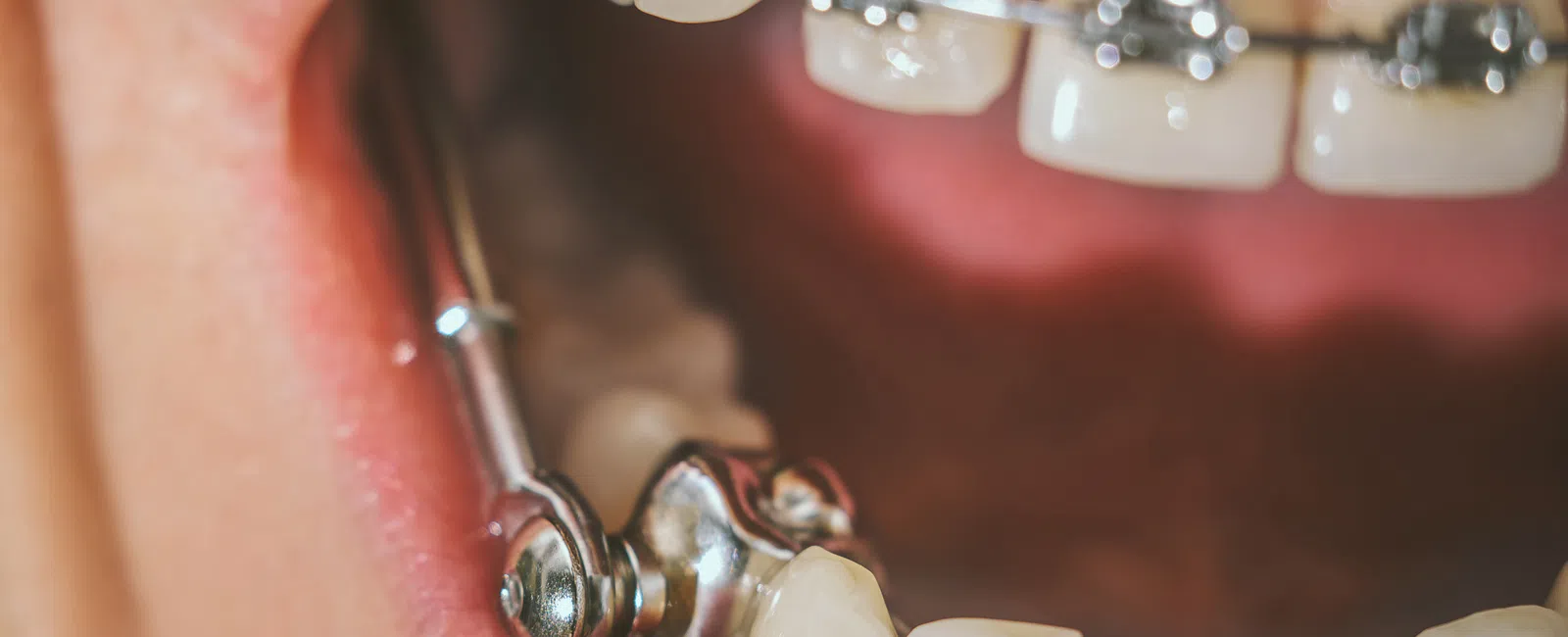 Close-up of teeth with braces and orthodontic headgear inside an open mouth.