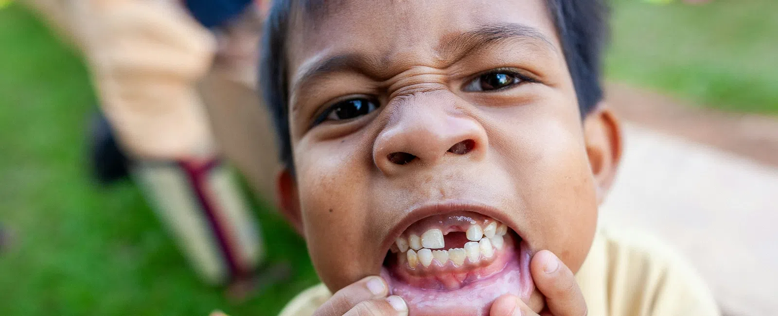 Close-up of young boy showing missing front tooth and playful facial expression outdoors.