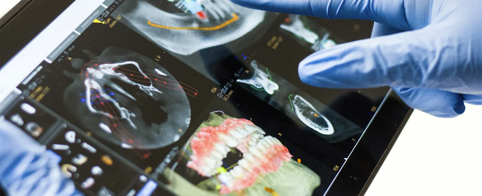 Gloved hands pointing at dental X-ray images on a digital tablet for oral health analysis.