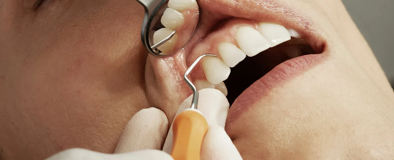 Close-up of dental examination showing a endodontist using tools to inspect a patient's teeth and gums.