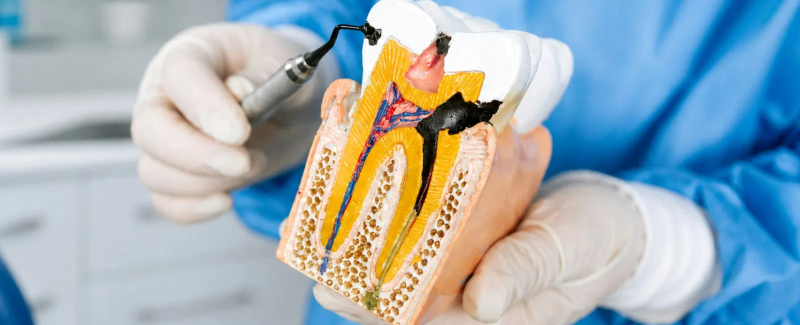Dentist in blue gloves holding a detailed cross-section model of a tooth with dental decay and tools.
