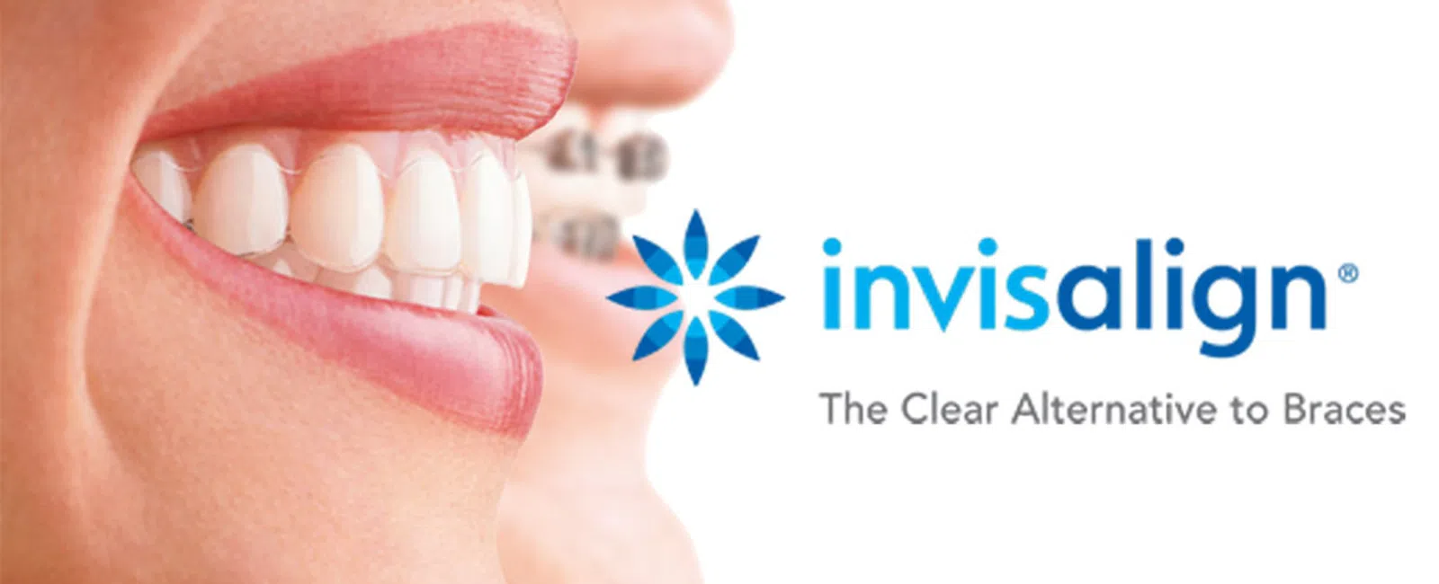 Close-up of smiling lips showing clear Invisalign aligners on teeth with logo and tagline on white background.