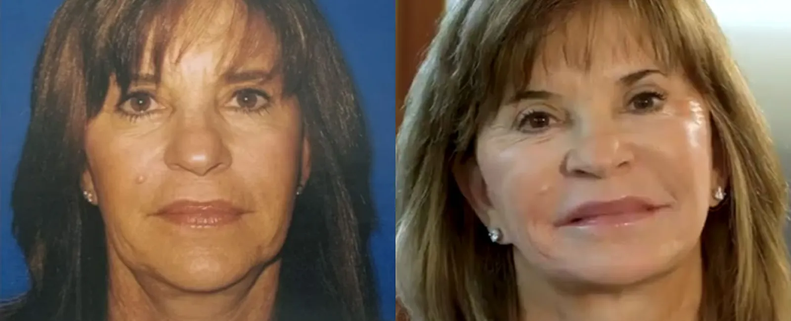 Facelift Video Case Study – Real People, Real Results