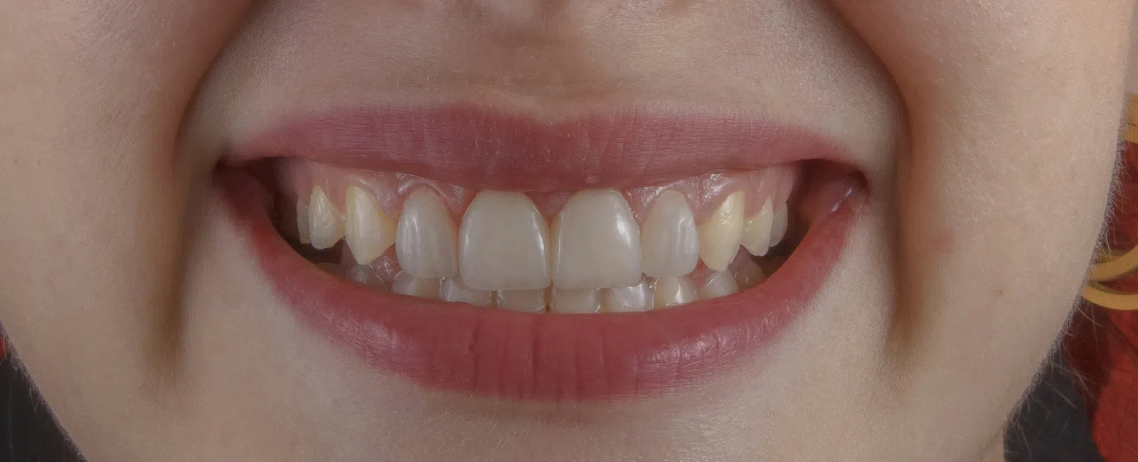 Close-up of a smiling person showing irregular and misaligned teeth with visible gums and lips.