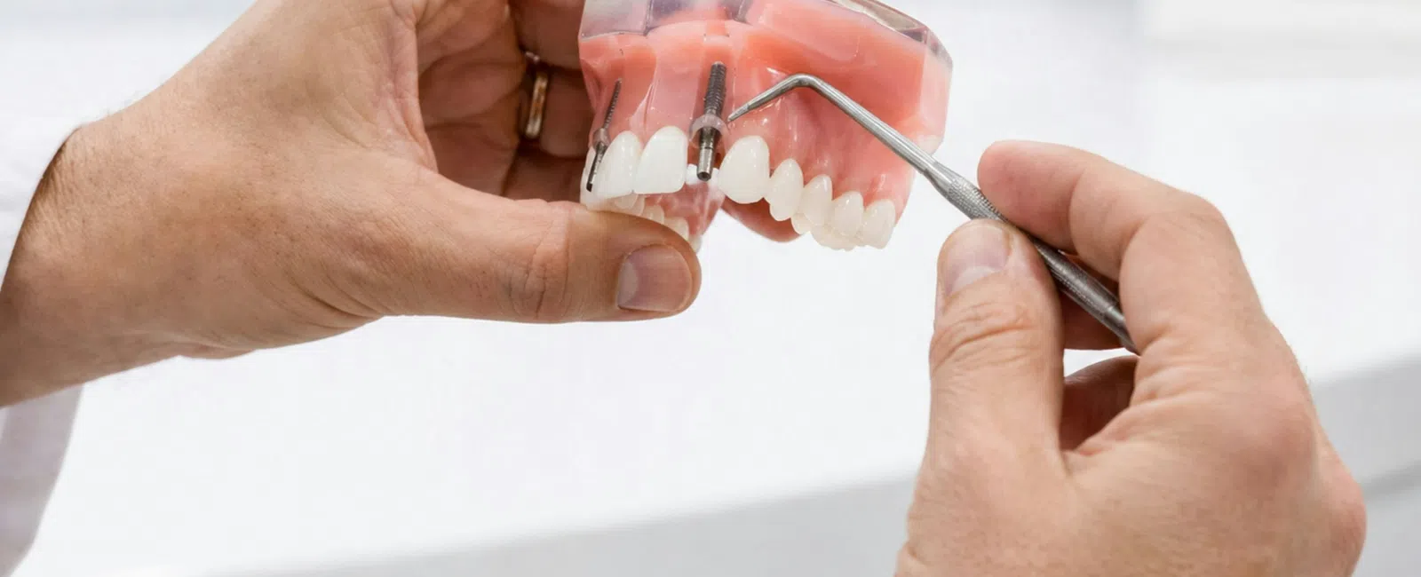 What Is The Difference Between Dental Crowns And Bridges?