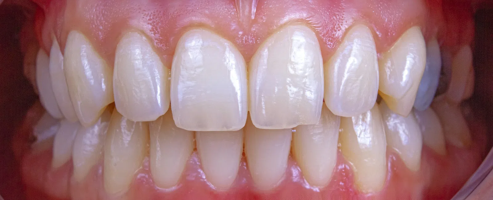 Close-up of healthy upper and lower teeth with pink gums and minimal plaque.