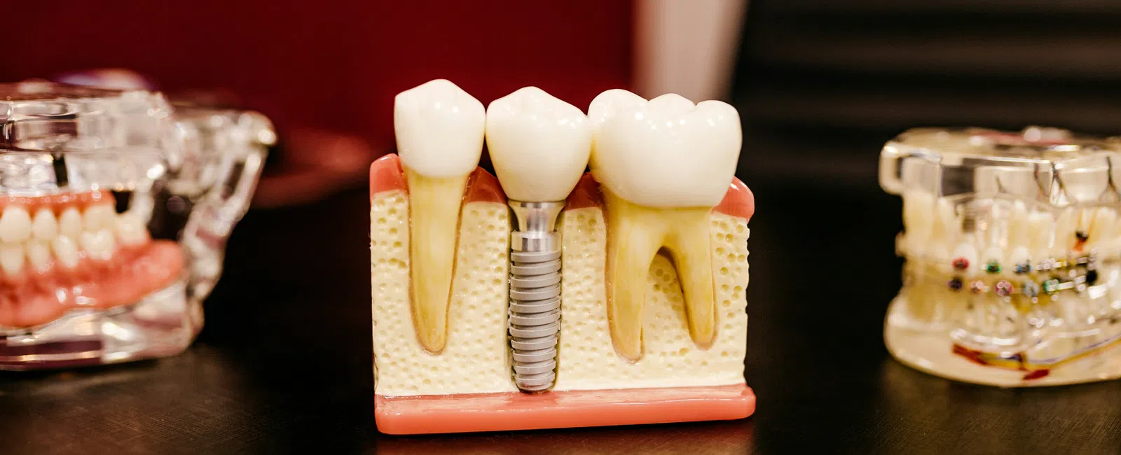 Dental model showing natural teeth and a metal dental implant embedded in gum and bone tissue.