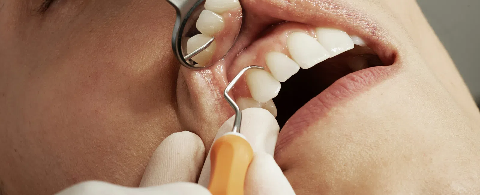 Close-up of dental checkup showing dentist holding dental mirror and scaler near patient's open mouth.