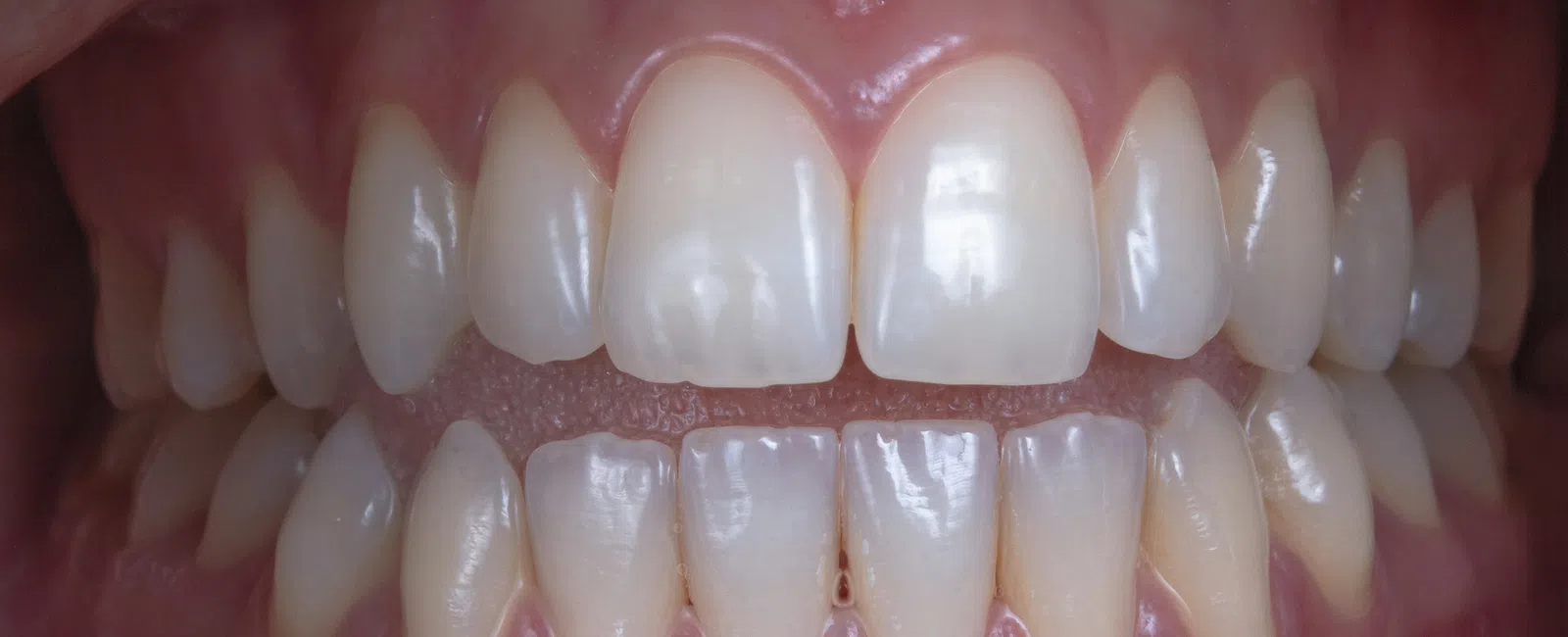 Close-up of healthy human teeth and gums showing upper and lower front teeth with slight gap