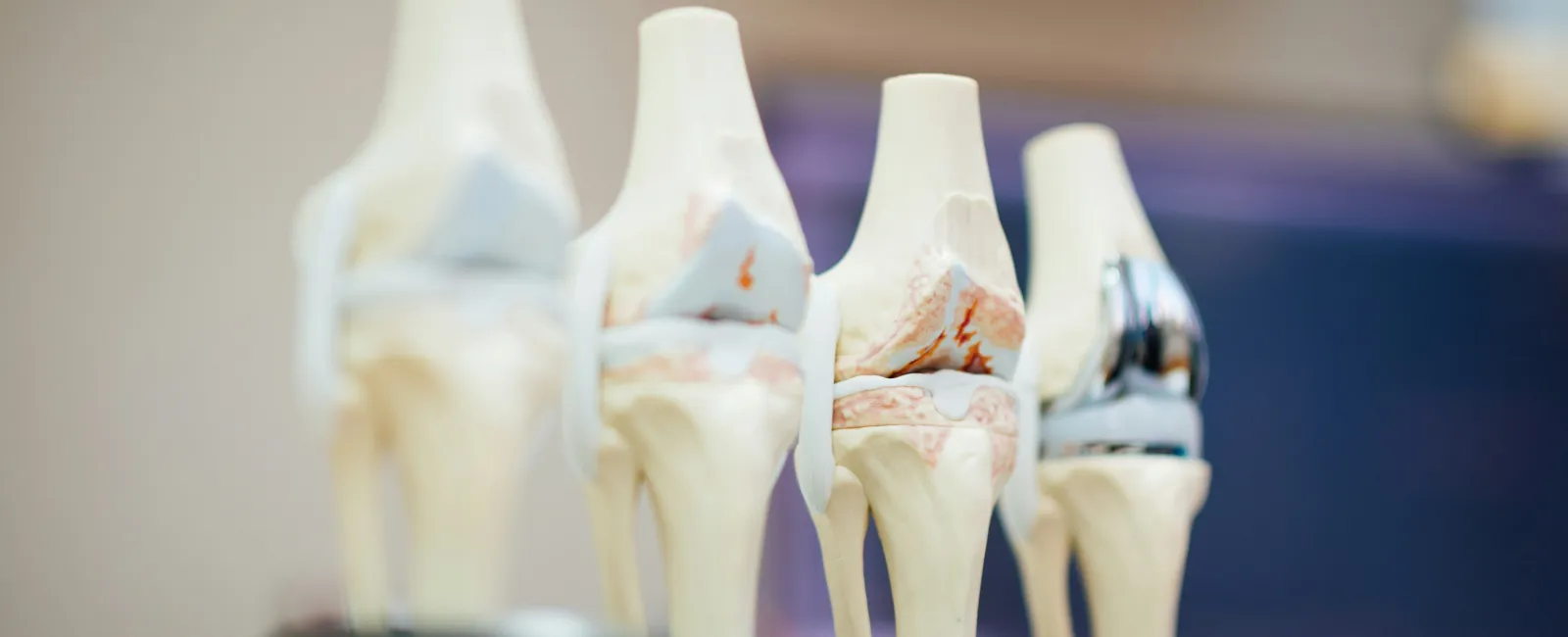 Four anatomical knee joint models showing progression of joint damage and replacement prosthesis on a blurred background