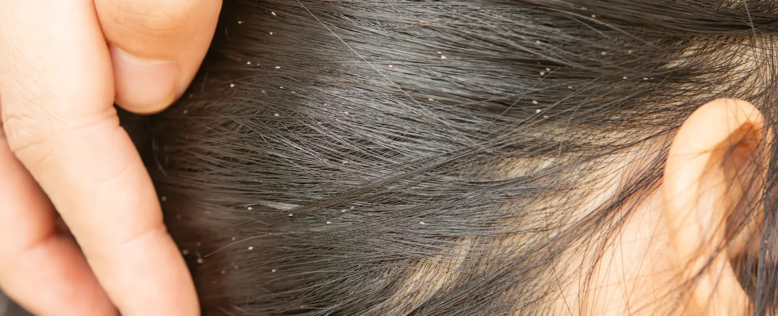 Head Lice Prevention: A Back-to-School Must