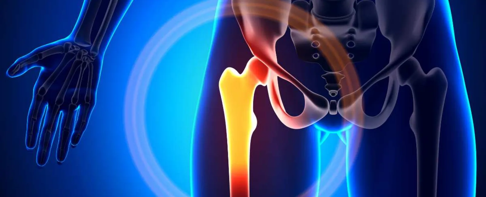5 Clear Signs That You Need a Hip Joint Replacement
