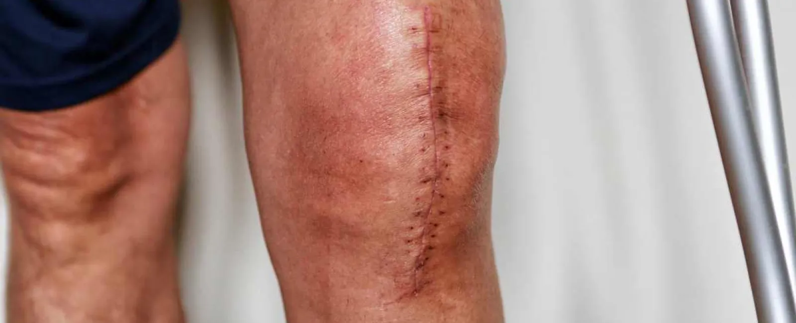 The Dangers of Delaying Knee Replacement Surgery