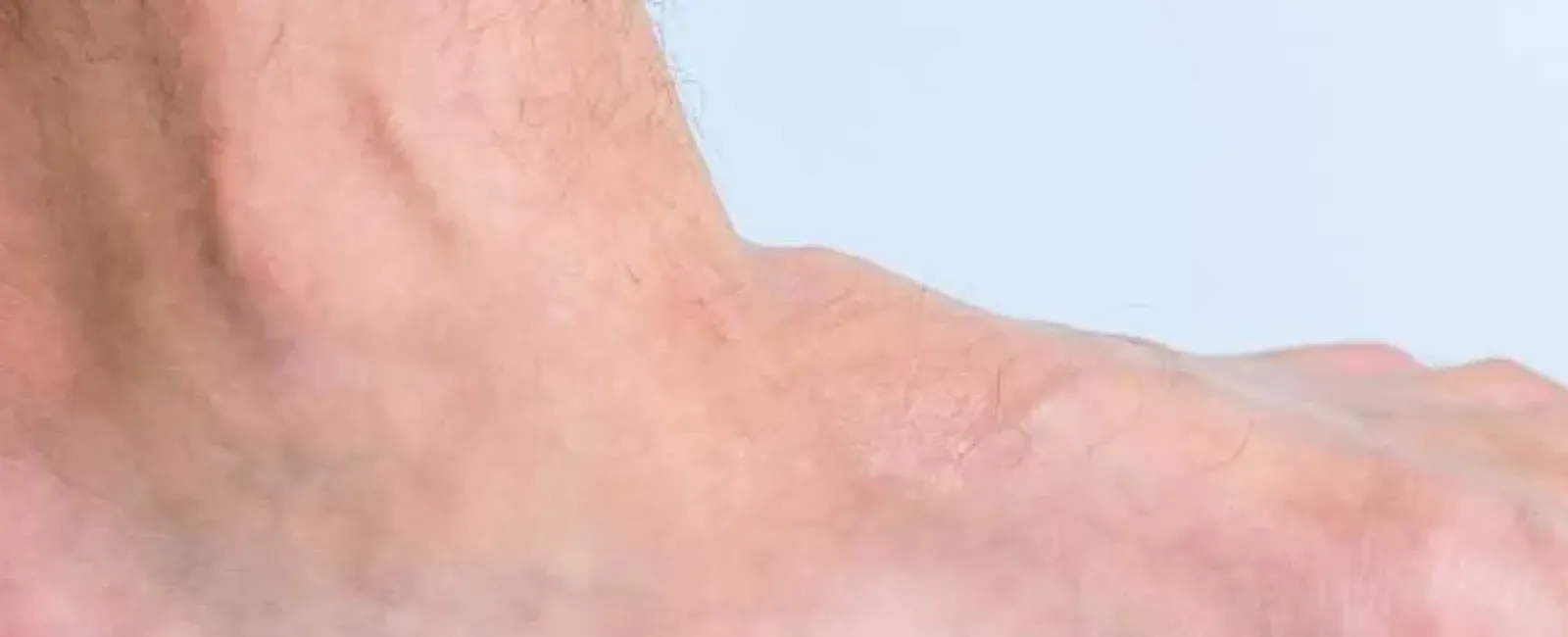 Managing Flatfoot and Arch Pain