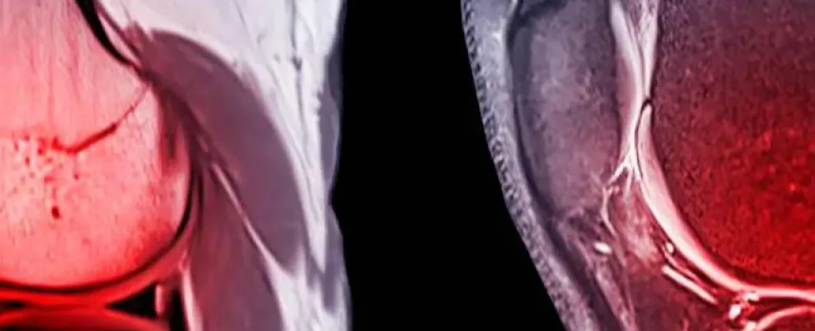 Anterior Cruciate Ligament (ACL) Tears and Treatment Options