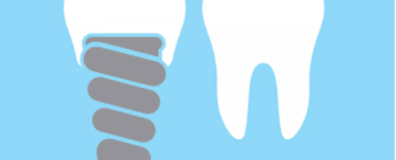 Learning The Lingo – Dental Implants