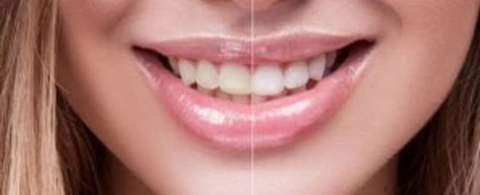 Teeth Bleaching Vs. Teeth Whitening