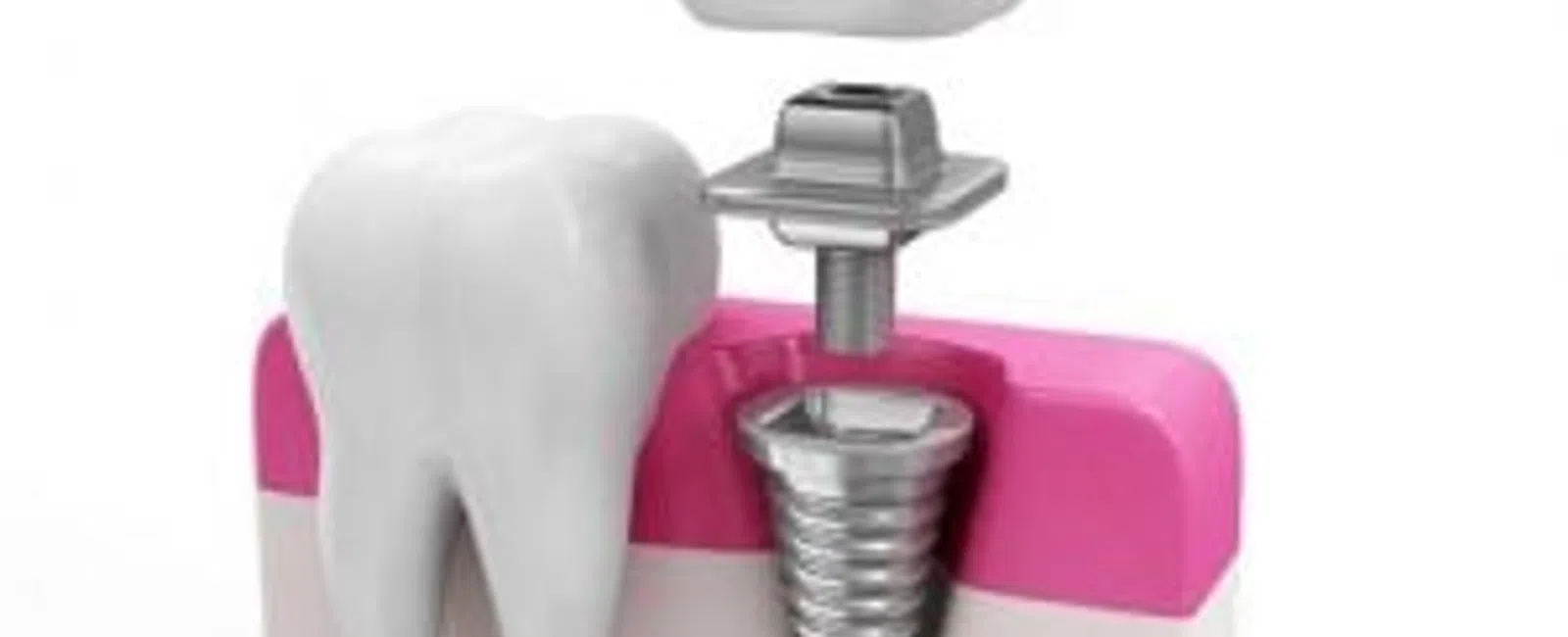 Dental Implants: High Tech Teeth