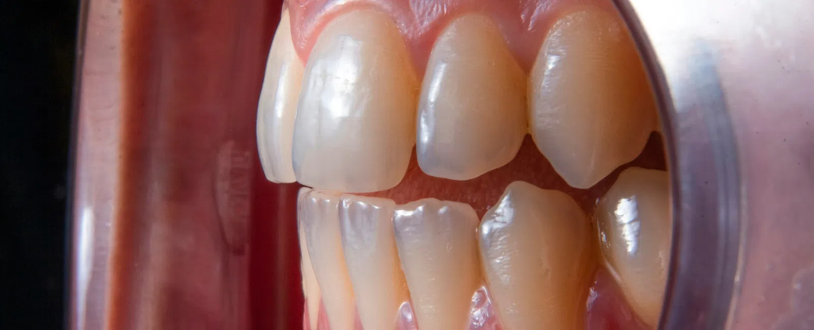 Close-up of human teeth and gums with dental cheek retractor showing upper and lower teeth