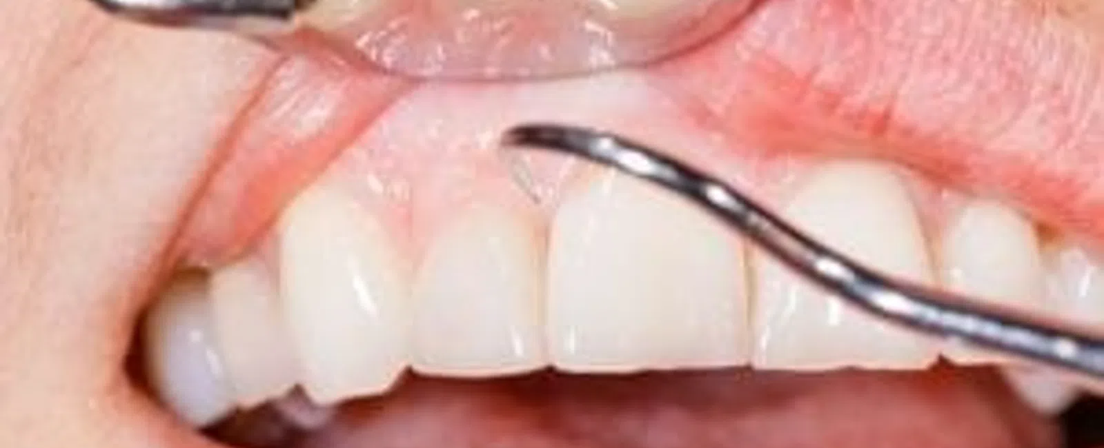 5 Facts About Gums