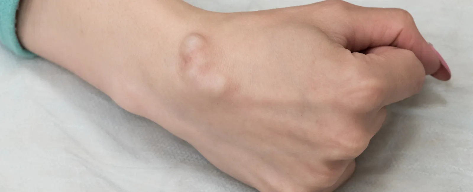 Understanding Mass Excision Of Cysts