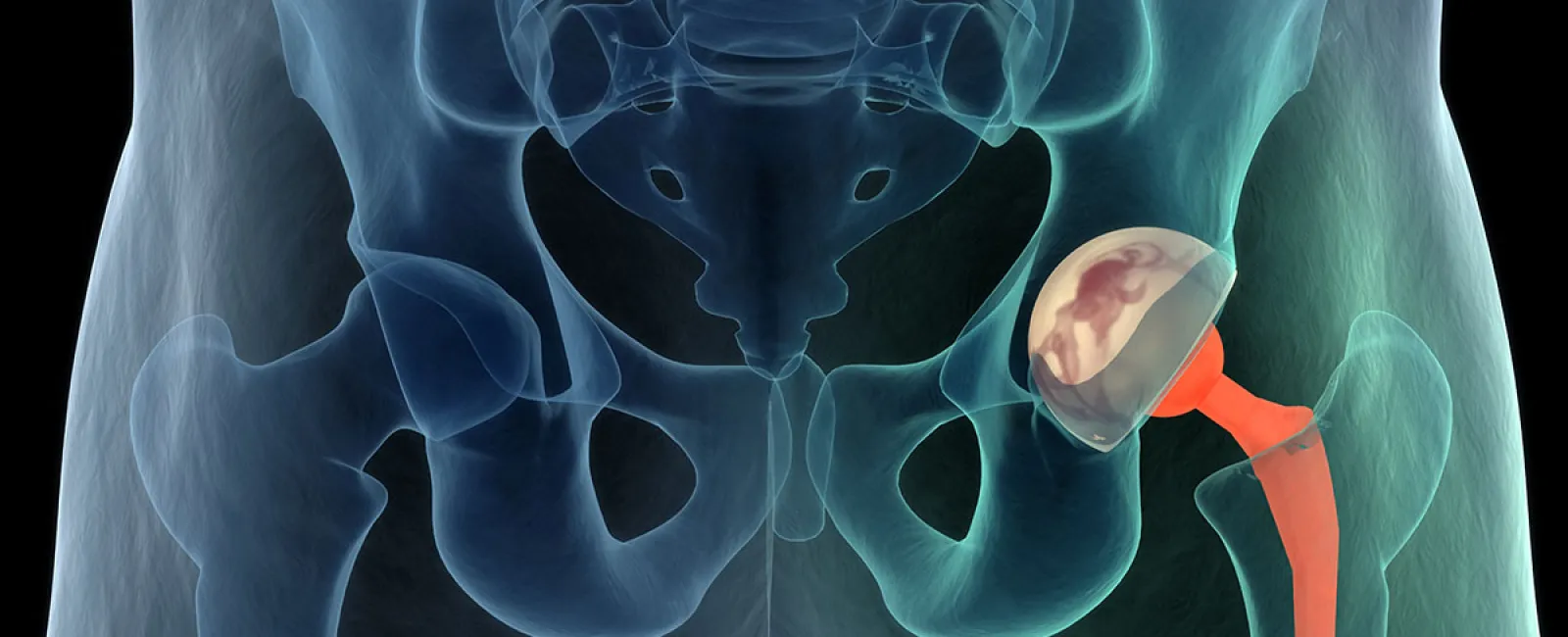 What is Direct Anterior Hip Replacement?