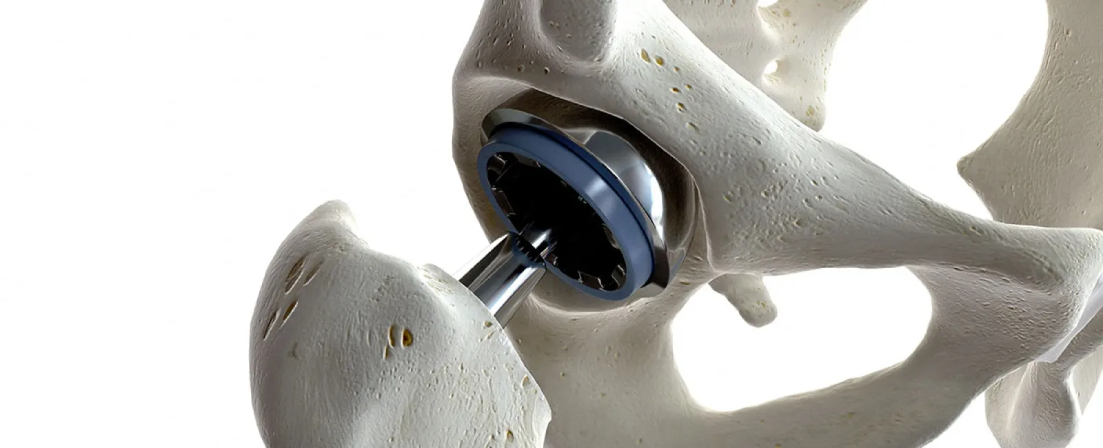 Tips for Recovering from Total Hip Replacement