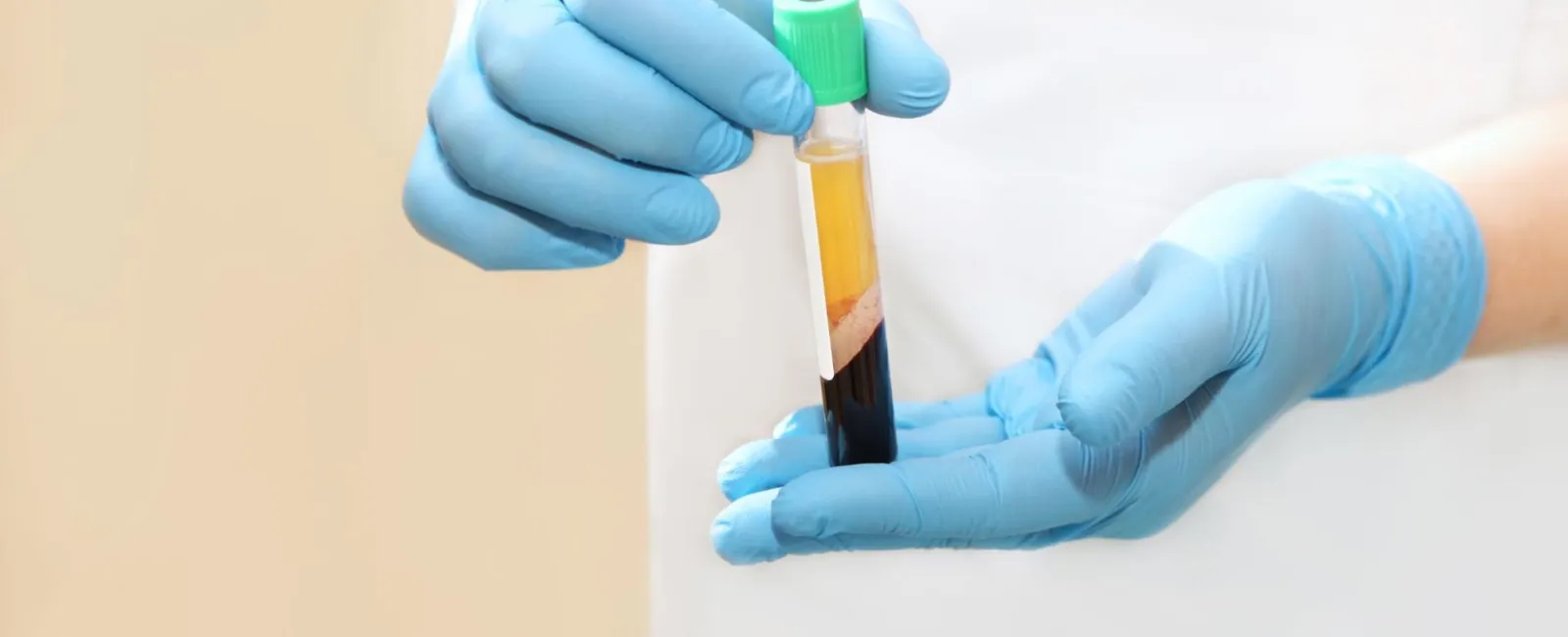 Platelet-Rich Plasma (PRP) Therapy: Can It Help You Heal?
