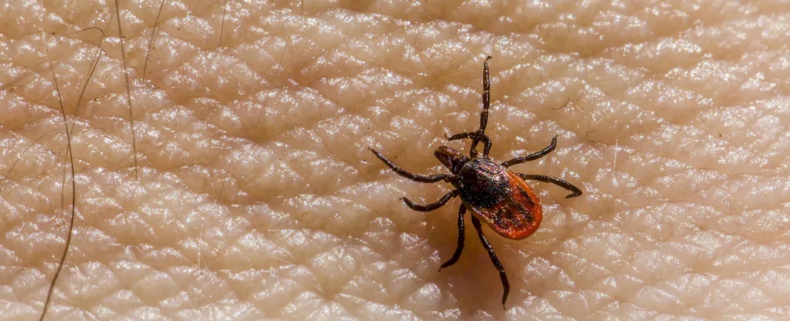 Close-up of a black and red minnesota tick crawling on textured human skin with hair strands visible.
