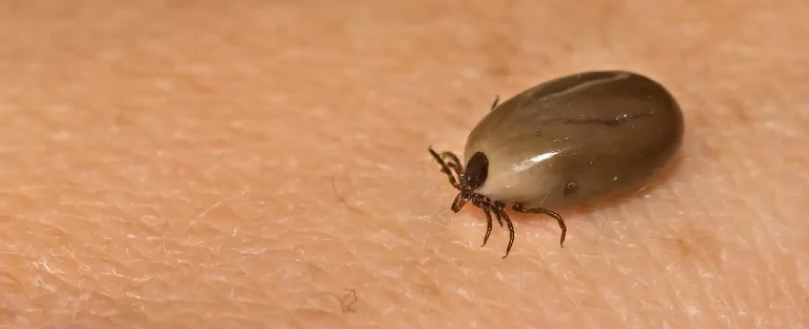 Close-up of a swollen tick embedded in human skin with visible legs and body details.